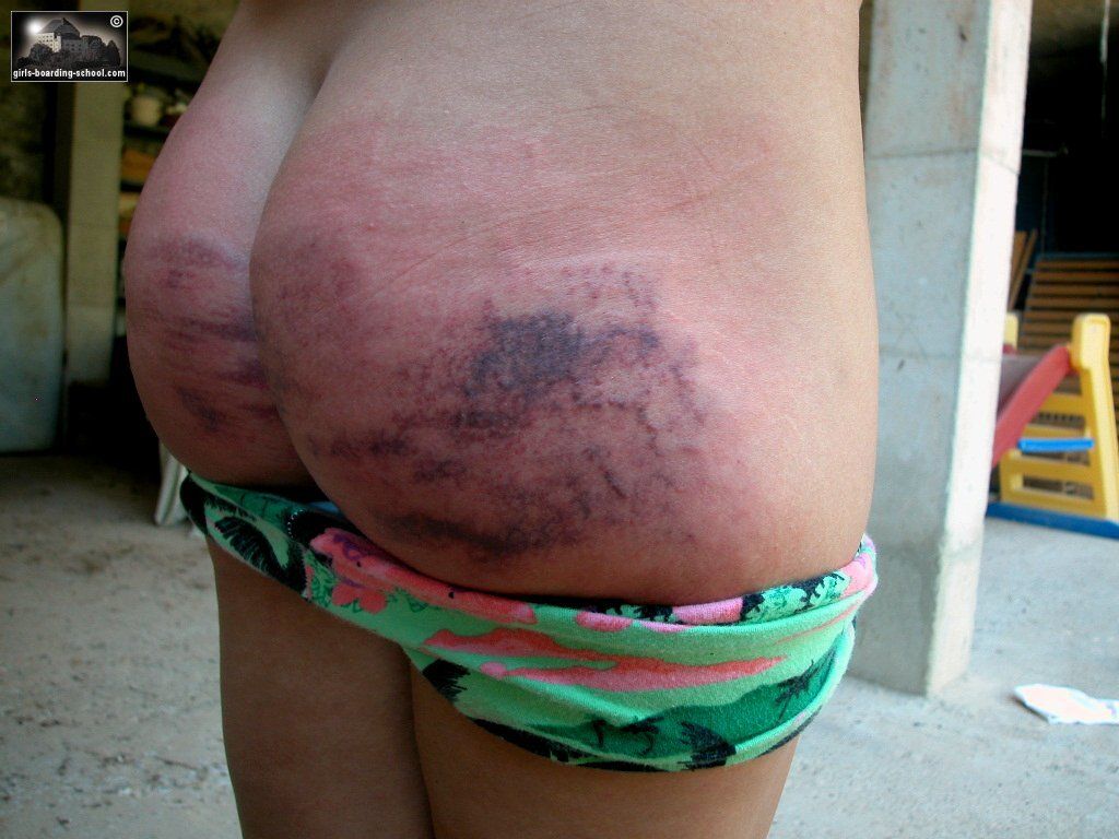 Spanked Bruised Black Ass - Big Fat Ass Spank Bruise | Sex Pictures Pass